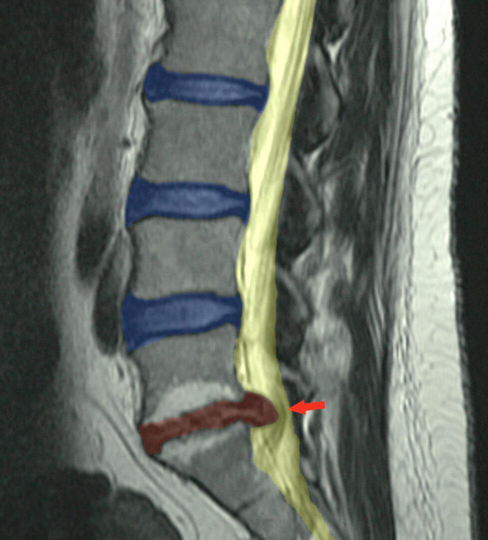 Spinal Disc Problems and Management