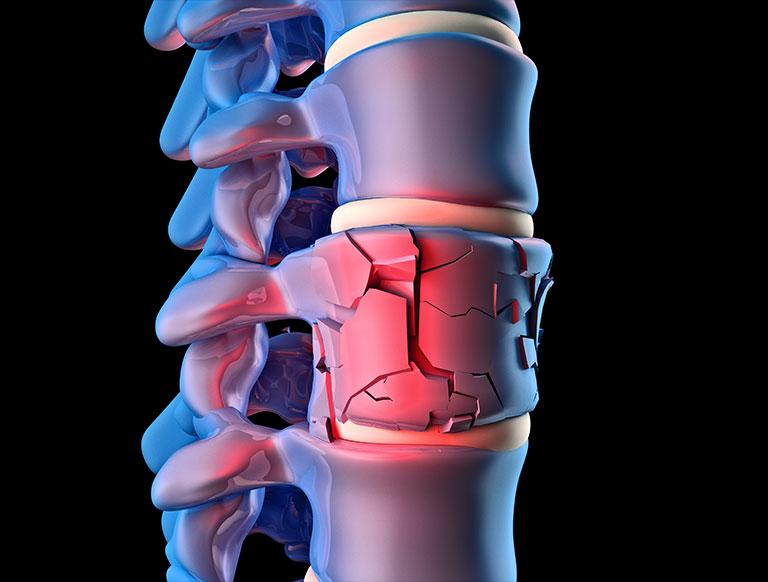 Spine Trauma Surgery
