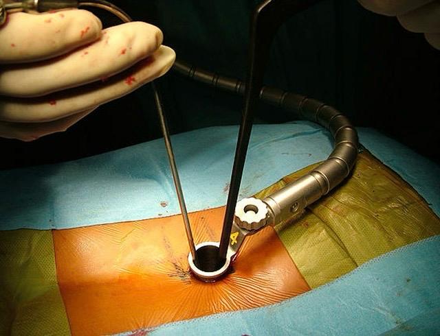 Minimally Invasive Spine Surgery