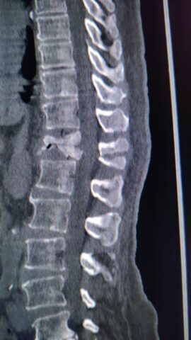 Unstable spine fracture managed with cement augmentation and minimally invasive procedure