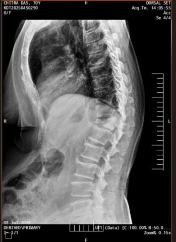 Unstable spine fracture managed with cement augmentation and minimally invasive procedure