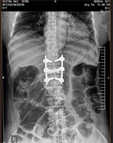 Unstable spine fracture managed with cement augmentation and minimally invasive procedure