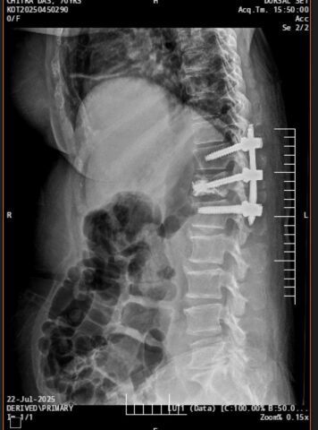 Unstable spine fracture managed with cement augmentation and minimally invasive procedure